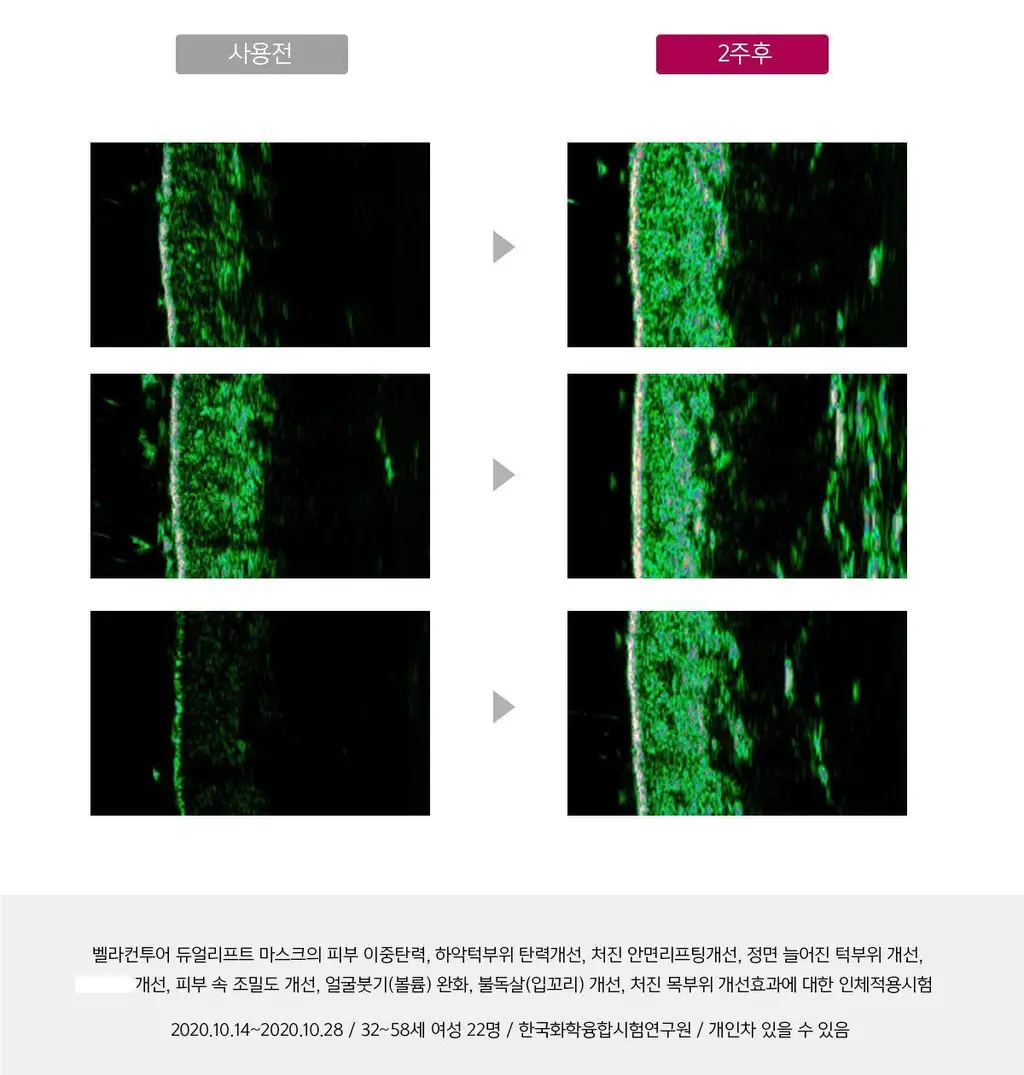 [브이라인/리프팅 패치] 아나시스 벨라컨투어 듀얼리프트마스크 5매 상세페이지 11